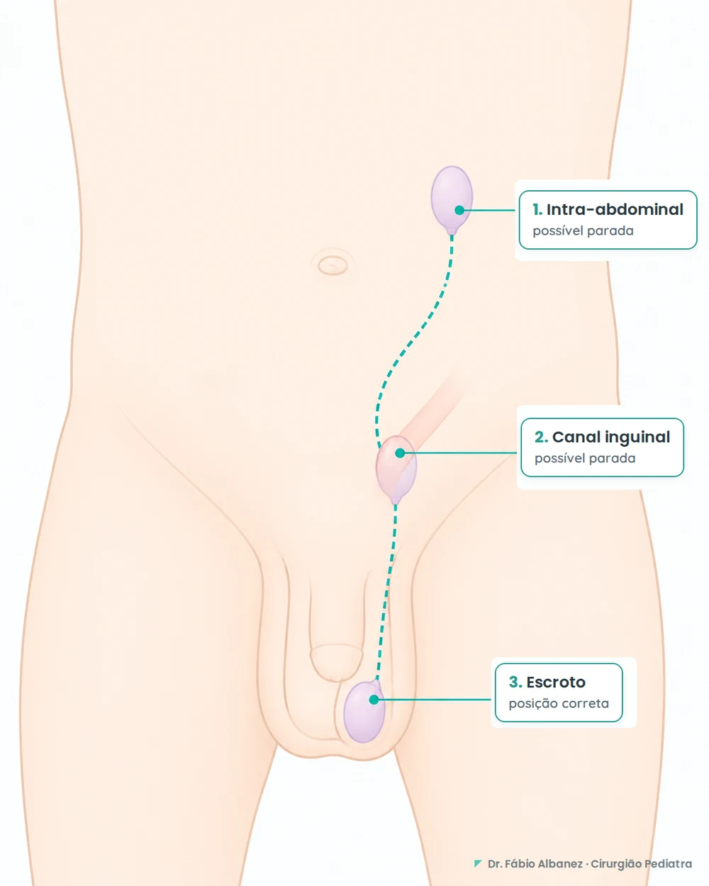 Esquema do trajeto de descida do testículo em bebê, com as três posições possíveis: intra-abdominal, canal inguinal e escroto (posição correta)