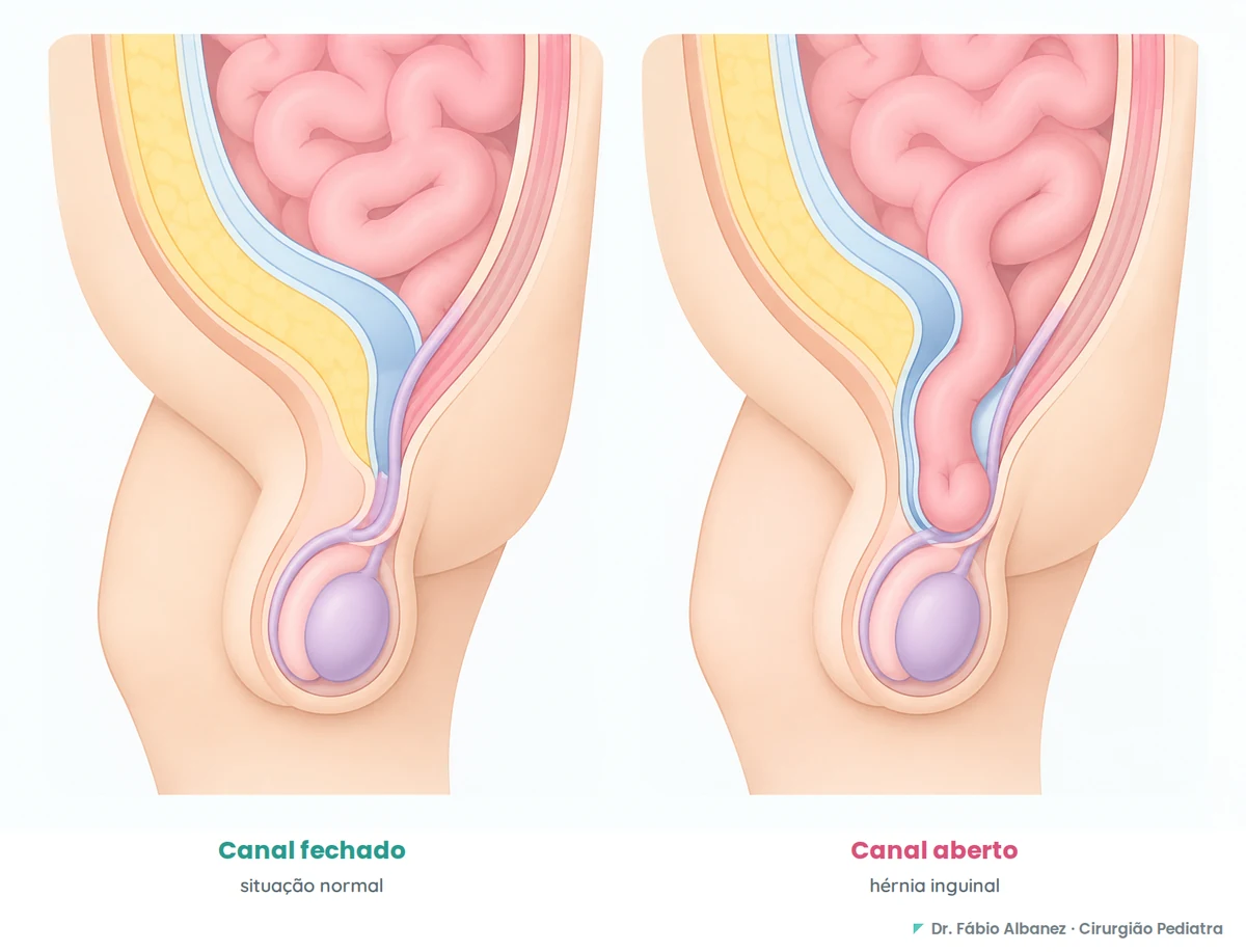 Esquema comparativo do canal inguinal em criança: à esquerda o canal fechado, situação normal; à direita o canal aberto com alça intestinal, formando a hérnia inguinal