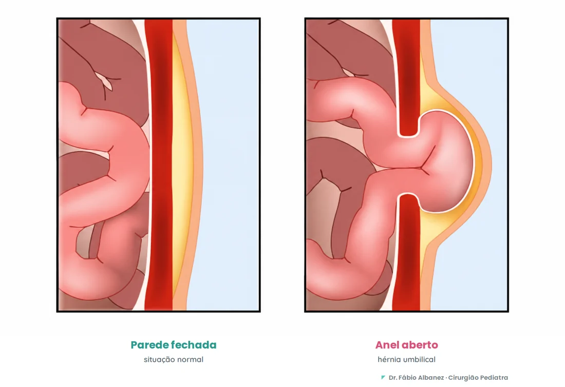 Corte transversal comparando a parede abdominal fechada (normal) e o anel umbilical aberto, por onde uma alça intestinal se projeta formando a hérnia umbilical